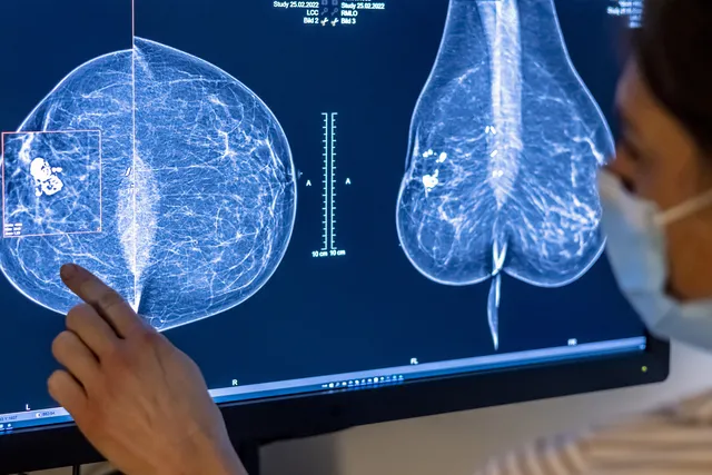Google Teams with iCAD in designing technology detecting breast cancer through '3D Mammography.'