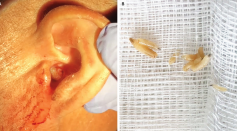 Images show New World screwworm fly larvae inside a Portuguese man's ear (left) and after being removed (right). The larvae had damaged part of his eardrum.
