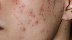 Acne is a skin condition that occurs when the follicles of your hair get plugged with oil and dead skin cells.