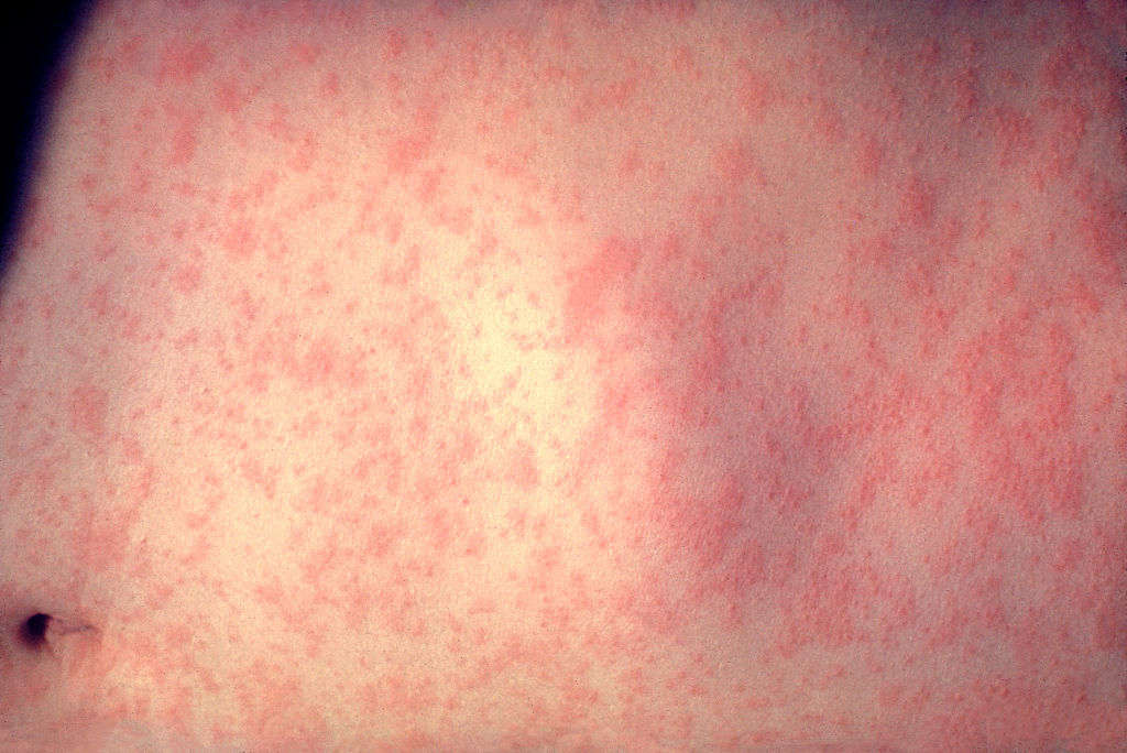 Rapidly Growing Measles Outbreak in Ohio Infecting 82 Children Linked