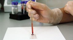  How Can Blood Test Predict Alzheimer's Disease Risk? Scientists Looked at Changes in Neurogenesis Prior to Clinical Diagnosis
