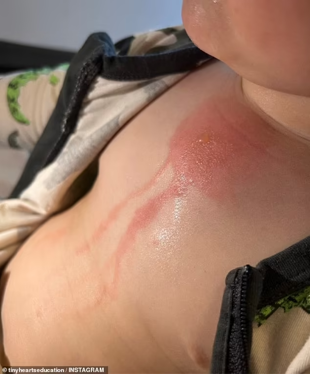 The Tiny Hearts Foundation shared photographs showing a burn covering the chest of the child, as well as blisters and blood