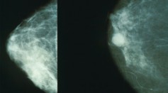 New AI Algorithm Could Help Unsuitable Candidates Avoid Serious Side Effects From Breast Cancer Therapy