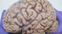 New Brain Disease Found in 3 Kids Could Help Understand Dementia, Alzheimer's [Study]