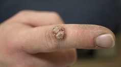 How Warts Are Removed? Medicines, Tips to Get Rid of Verrucas