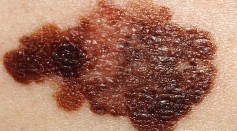 Personalized Vaccine, Immunotherapy Drug Keep Patients With Melanoma Cancer Free For Over A Year [Study]