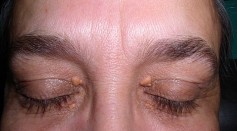 Genetically High Cholesterol Leaves Woman With Worst Eye Bags; What Is Xanthelasmas?
