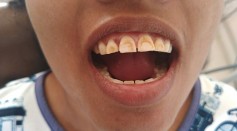 Why Are My Teeth Yellow? Here’s How You Can Remove Teeth Stains