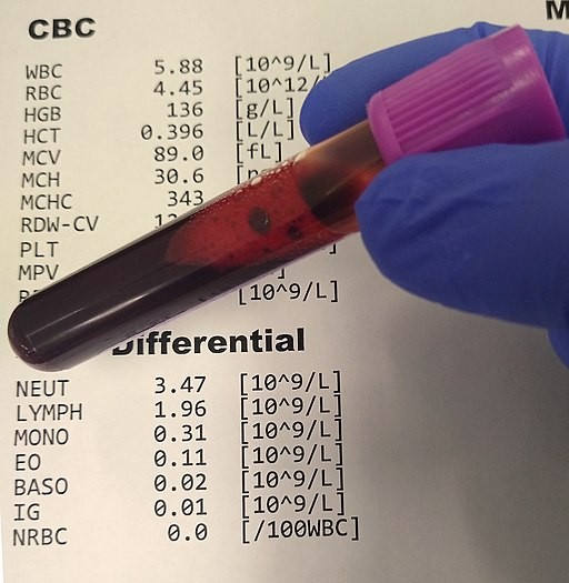What Level of RDW is Dangerous? Understanding the Blood Test and Interpreting the Results