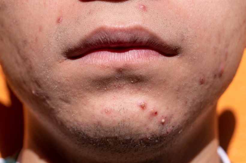 Revolutionary Acne Treatment Uses Nanoparticles 1,000 Times Smaller Than a Hair Strand 