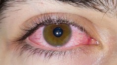 Pink-Eye Outbreak Hits 400,000 Individuals in Pakistan; What Is It?