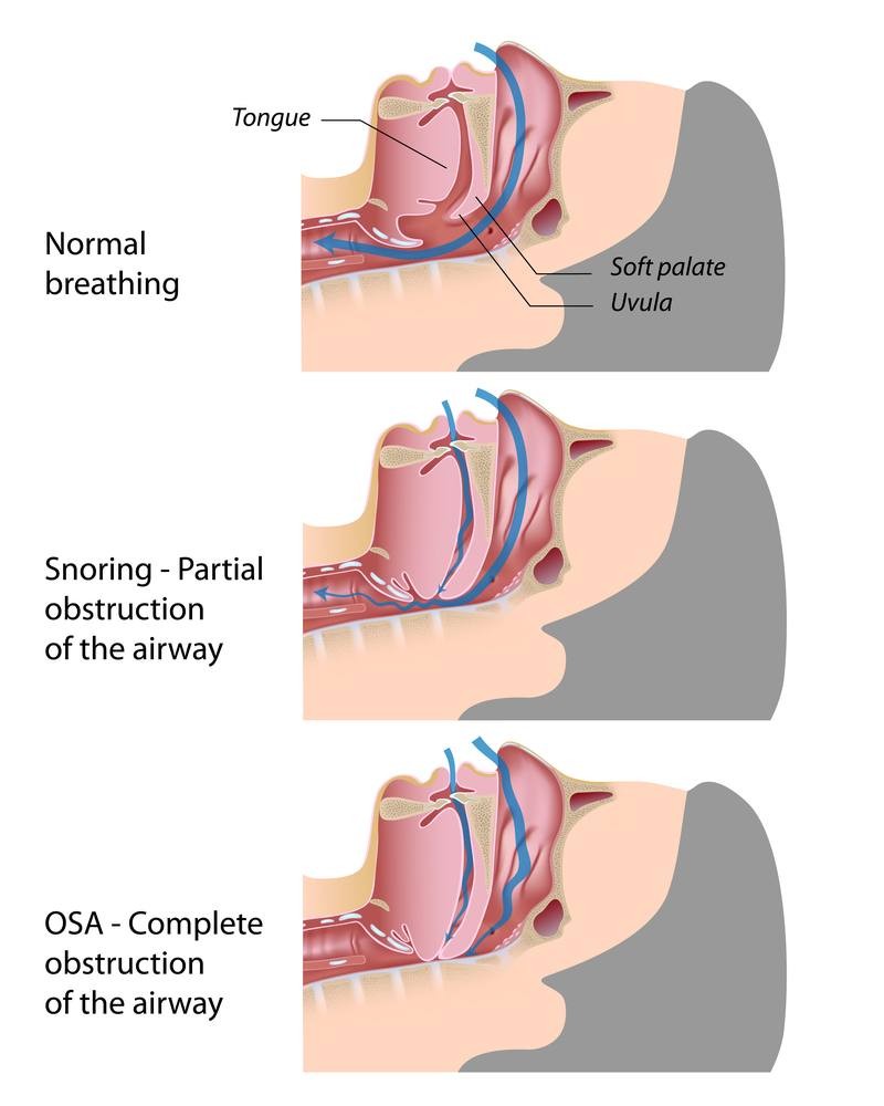 Fig. 3 Obstructive Sleep Apnea Diagram