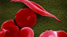 Casgevy: Key Insights Into the First-Ever CRISPR Gene-Editing Therapy Approved for Sickle Cell Disease