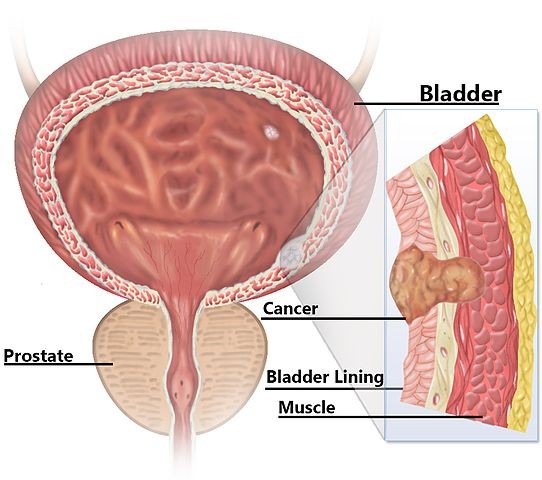Nanorobots Powered by Urea Effectively Decrease Tumor Volume in Bladder Cancer by 90%