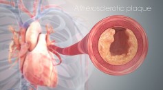  Cardiovascular Imaging Technique Combines Optical Methods To Assess Plaque Structure, Prevent Heart Attacks and Strokes