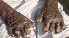 Leprosy Cases Surge in the US; How to Spot Infectious Disease