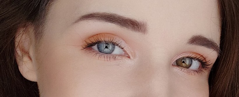 Heterochromia of the Eye: How Can a Single Person Have Two Different Colors of Iris?