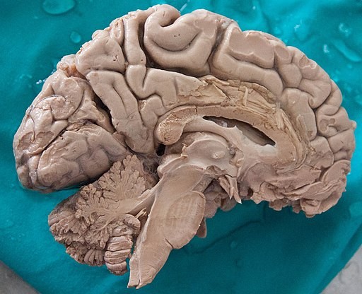 Humans Brains Are Growing in Size, Possibly Lowering Risk of Dementia