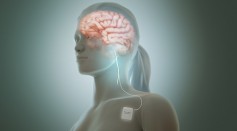 How Does Vagus Nerve Stimulation Work? Could This Be the Secret Weapon in Fighting Stress?