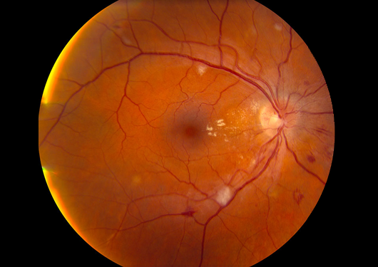 Hypertensive Retinopathy High Blood Pressure