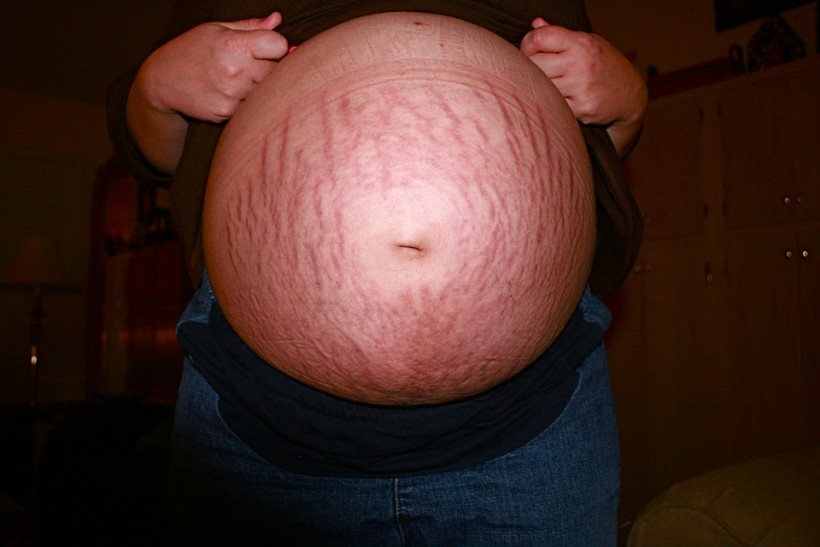 Pregnancy is one of the main causes of stretch marks. 
