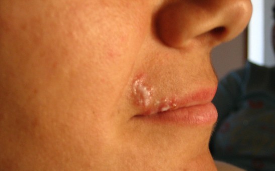 HSV-1 or Oral Herpes