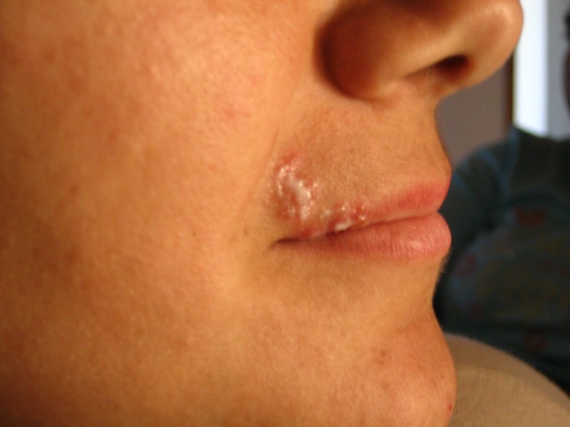 HSV-1 or Oral Herpes