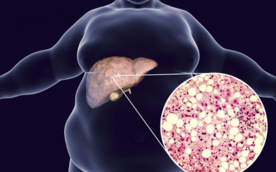 First-of-its-Kind Antisense Drug May Become Novel Treatment for Fatty Liver Disease