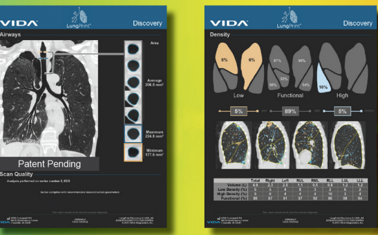 VIDA Diagnostis Inc. Receives FDA Clearance to Advance AI LungPrint Solution