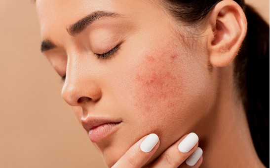  How to Reduce and Lighten Acne Scars