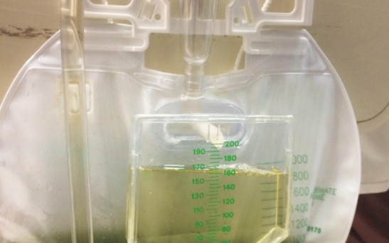 Why is This Man's Urine Green? Doctors Explore the Reason of this Rare Case Study