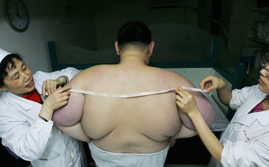 Clinic In Wuhan Treats Obese Teenager With Acupuncture