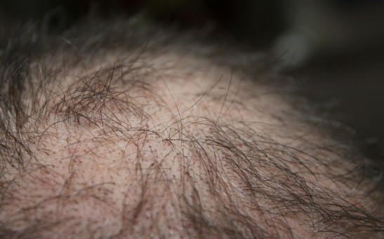 How to Treat Stress-Induced Hair Loss? Expert Discusses 3 Ways to Effectively Reverse and Prevent Telogen Effluvium
