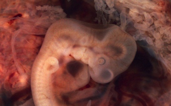 Tubal Pregnancy with embryo