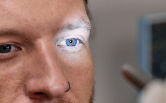 Science Times - 47-Year-Old British Man Gets the 3D-Printed Eye He’s Needed for More Than Two Decades, World’s First of Its Kind