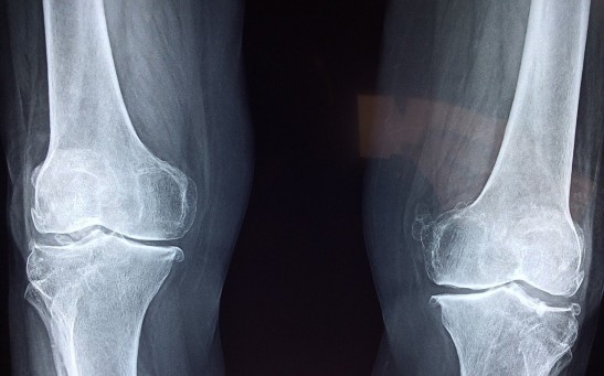  Arthritis Treatment: Knee Implant That Conducts Electric Current Stimulates Cartilage Regrowth to Heal Joints