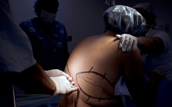 COLOMBIA-BEAUTY-HEALTH-SURGERY-POST BARIATRIC