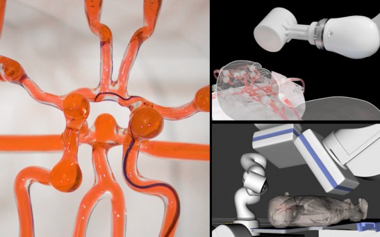 Robotic Arm Developed for Endovascular Surgery, Can Treat Stroke Patients Remotely