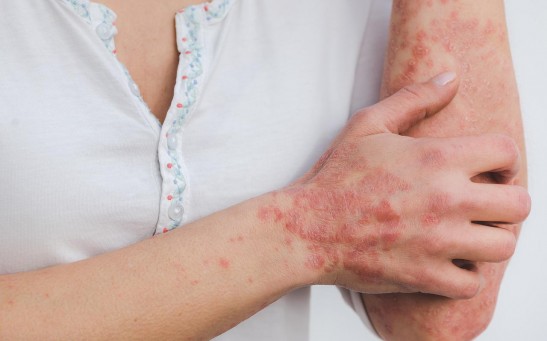  Psoriatic Arthritis and Psoriasis: Here's What People Should Know About Them