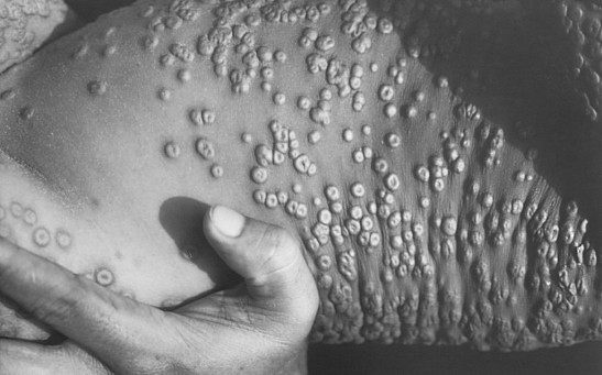 Smallpox Legions Are Shown In This 1973 Photograph In Bangladesh Drug Company Aventis Pa