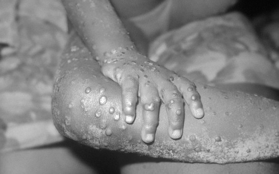  Living Through Monkeypox: Georgia Man Shares His Experience of Being Infected With the Once Rare Virus