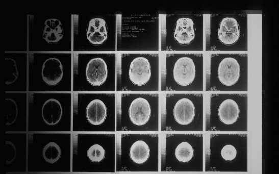  COVID-19 Infection Predisposes People to Irreversible Neurological Conditions and Accelerate Brain Aging, Study Shows