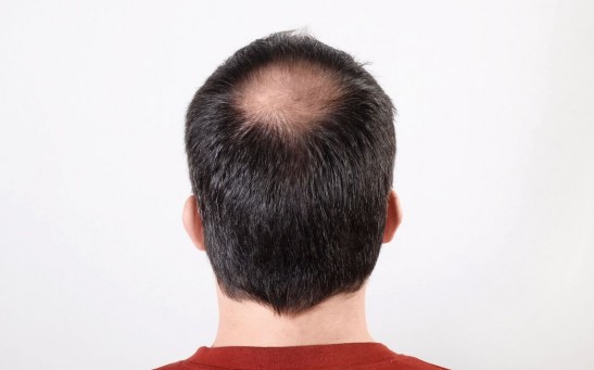 A man suffering from baldness