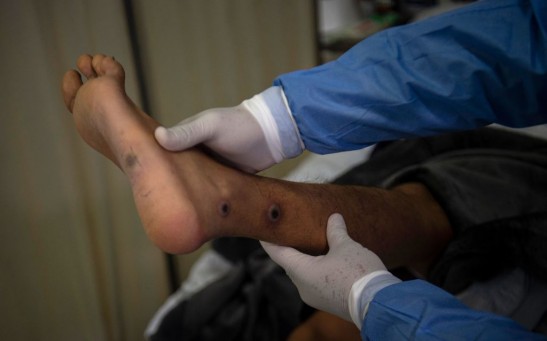 PERU-HEALTH-VIRUS-MONKEYPOX