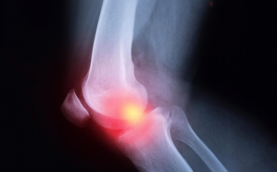 According to new research, taking anti-inflammatory pain relievers like ibuprofen and naproxen for osteoarthritis may actually worsen inflammation in the knee joint over time.