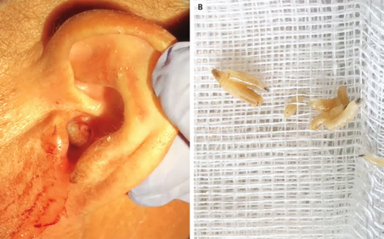 Images show New World screwworm fly larvae inside a Portuguese man's ear (left) and after being removed (right). The larvae had damaged part of his eardrum.