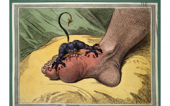 James Gillray's 1799 painting illustrates the painful symptoms of gout. 