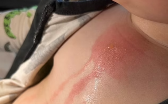 The Tiny Hearts Foundation shared photographs showing a burn covering the chest of the child, as well as blisters and blood