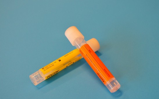Urine Test With A Novel Type of Nanoparticle Can Detect Cancer for Early Non-Invasive Diagnosis