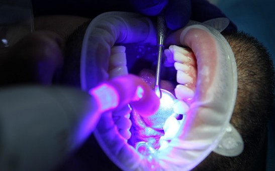 Do Oral Health Teeth Whitening Systems Work? Is It Safe for You?